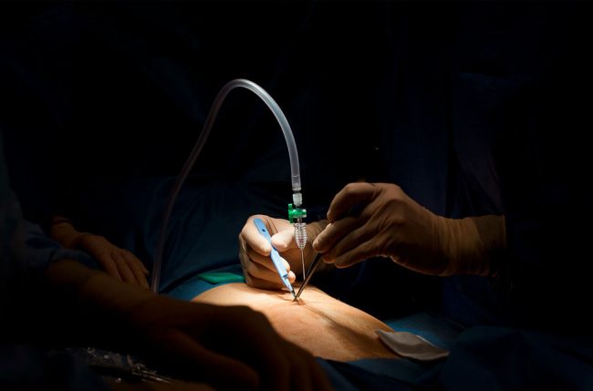 endometriosis